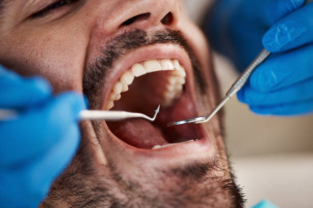 Best Knocked-Out Tooth (Avulsed Tooth) Treatment in Scappoose, OR
